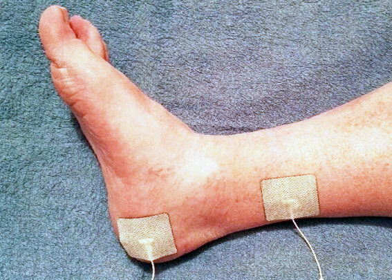 S.A.N.S. (Stoller-Afferente-Nerve-Sensitive)