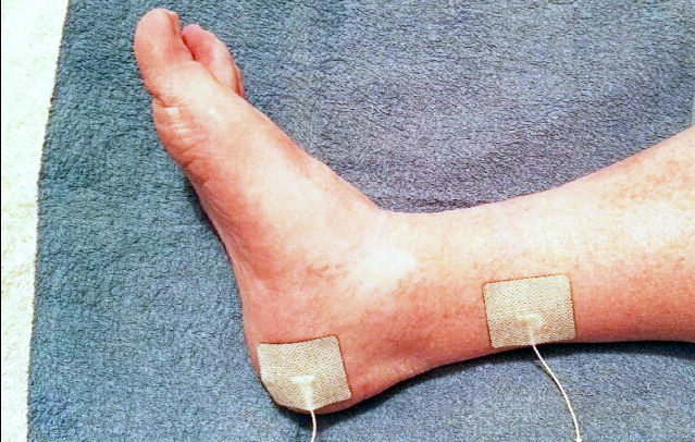 S.A.N.S. (Stoller-Afferente-Nerve-Sensitive)